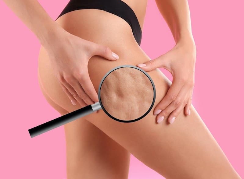 cellulite, come combatterla
